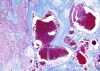 Cavernous malformation, trichrome stain